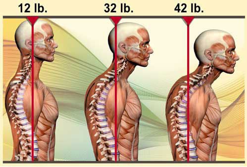 cervical-hypolordosis.jpg