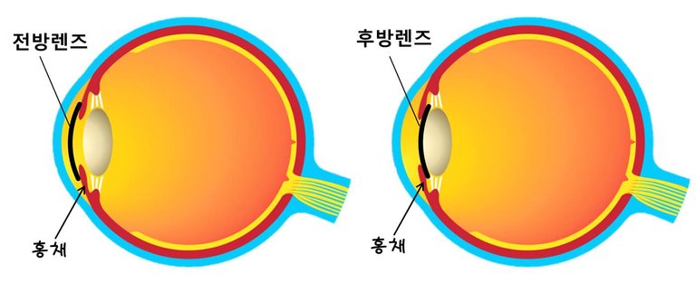 안내삽입술.jpg