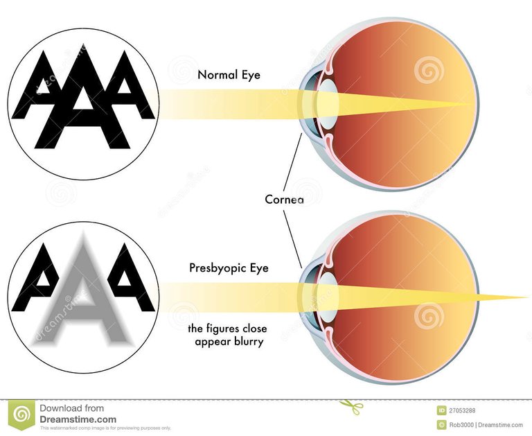 presbyopia-27053288.jpg