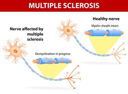 multiple-sclerosis.jpg