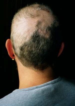 300px-Trichotillomania_1.jpg