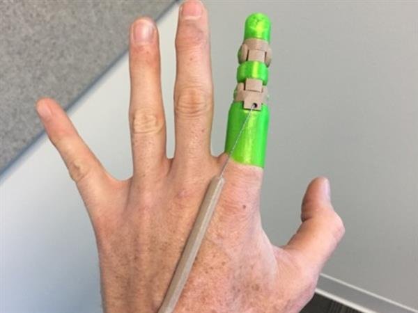 finger-amputee-shares-3d-printed-partial-finger-replacement-device-enable-2.jpg