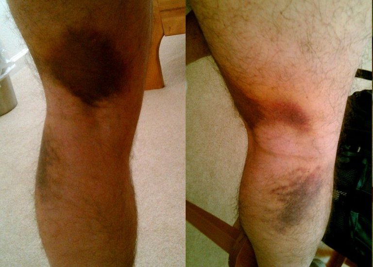 2010-10-02_pulled_hamstring.jpg