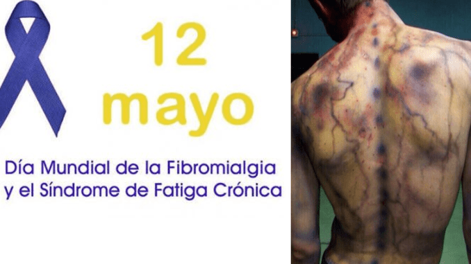fibromialgia.png