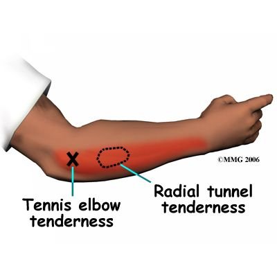 elbow_latepi_symptoms01_ihpba.jpg