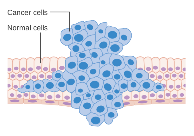 diagram_showing_a_tumour_forci.png