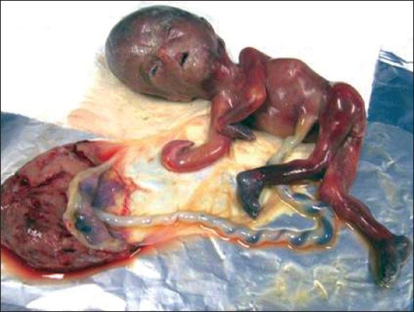 The-terminated-pregnancy-showing-different-abnormalities.png
