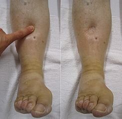 edema.jpg