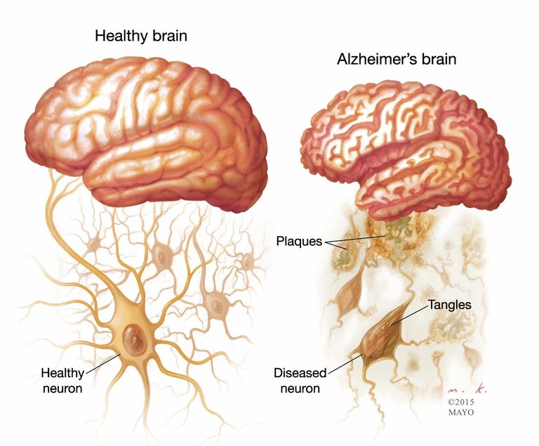 Alzheimers-001-1.jpg