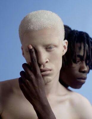 pose albinism.jpg