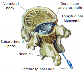 551px-Anestesia_spinaleENG.png