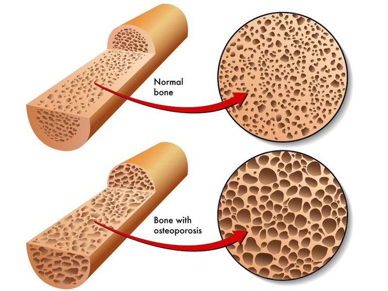 osteoporoticbone15472526_m.jpg