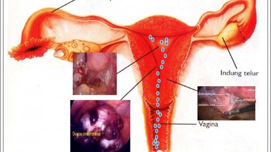 Radang-Vagina-540x303.jpg