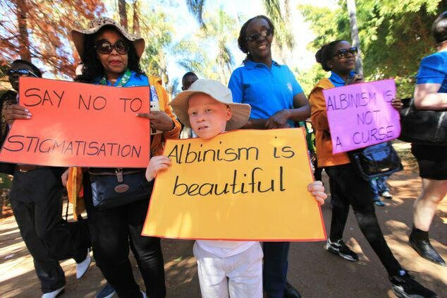 say no albinism.jpg