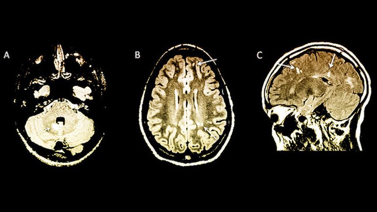 Researchers-Discover-MS-Risk-in-Children-Using-MRI-Brain-Scans.jpg