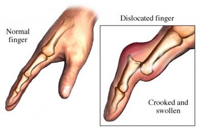 dislocated-finger.jpg