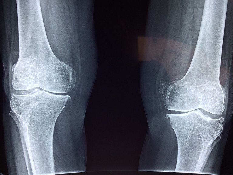 knee-2253047_1920.jpg