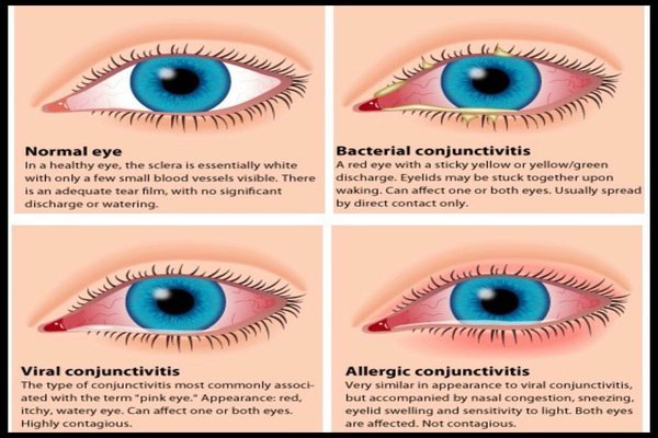 pink-eye-vs-allergies.jpg