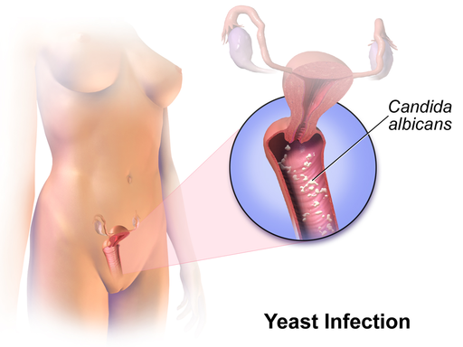 Yeast_Infection.png