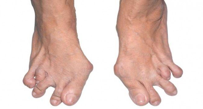 rheumatoid-arthritis-foot-655x353.jpg