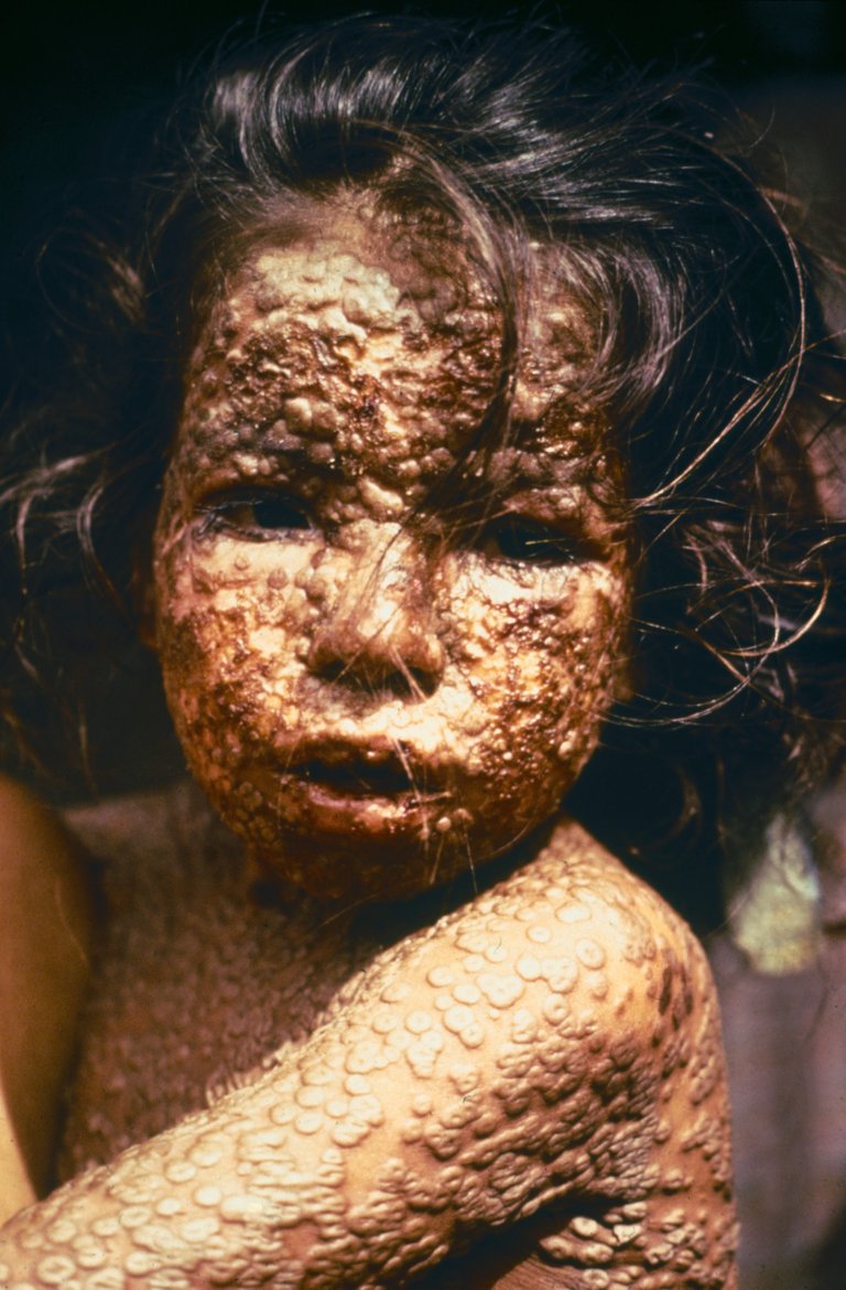 Child_with_Smallpox_Bangladesh.jpg