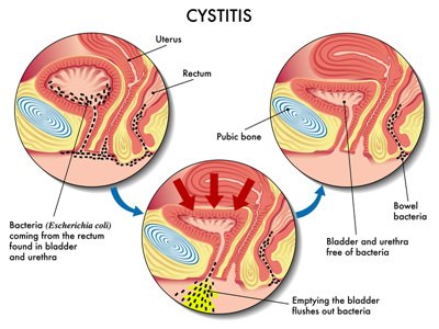 cystitispic(1).jpg