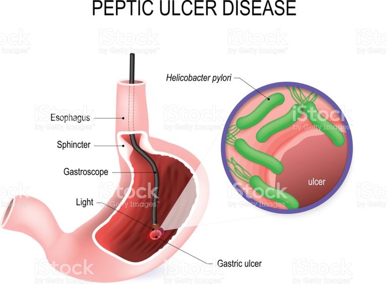 peptic-ulcer-disease-stomach-ulcer-or-gastric-ulcer-vector-id645454524.jpeg