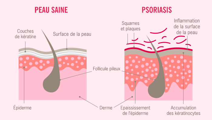 peau-saine-psoriasis.png