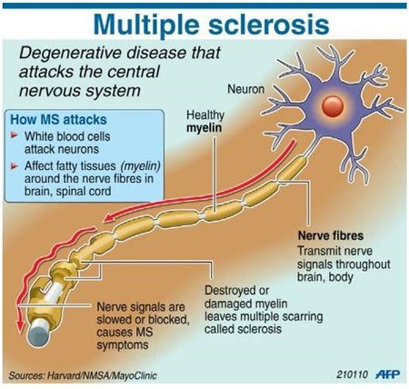 Multiple-Sclerosis-pill1.jpg