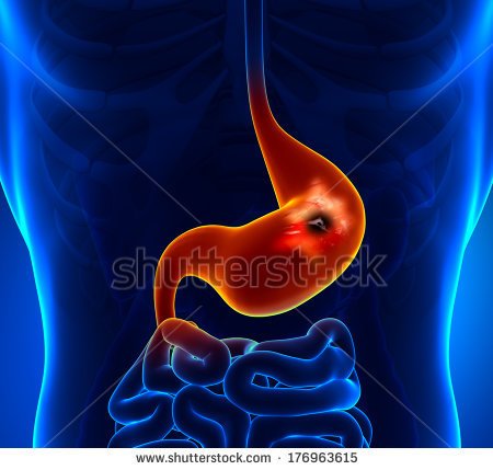 stock-photo-peptic-ulcer-176963615.jpg