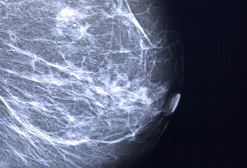 breast-cancer-s7-photo-of-mammogram.jpg