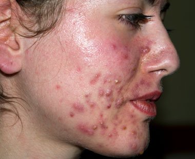 Acne.jpg