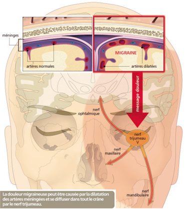 migraine_1.jpg