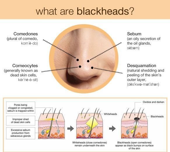 howtogetridofblackheads6.jpg