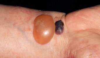 Bullous-pemphigoid_342x198_M2400553.jpg