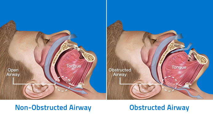 Anatomy-of-Obstructive-Sleep-Apnea.png