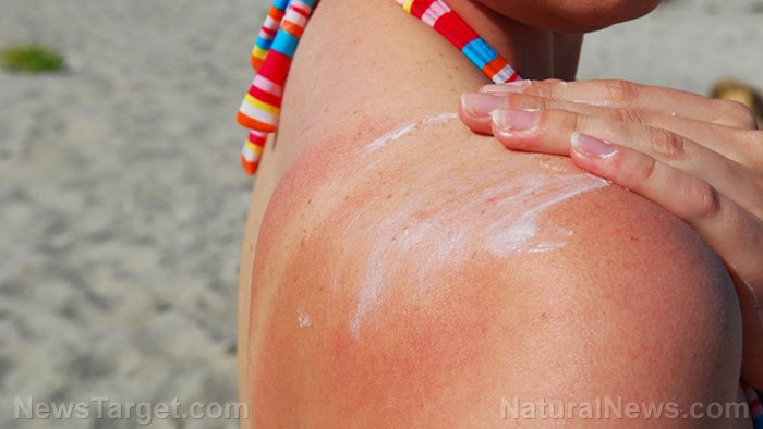 Sunburn-Lotion-Sunscreen-Shoulders-Skin-Rub.jpg