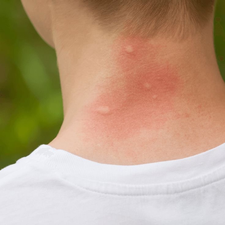 a4b4cc682149cae366d3639804b0caec--mosquito-bite-relief-remedies-for-mosquito-bites.jpg