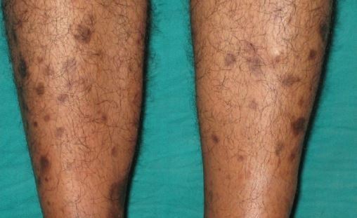 Brown-spots-on-legs.jpg