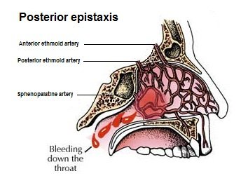 epistaxis_posterior_2013.jpg