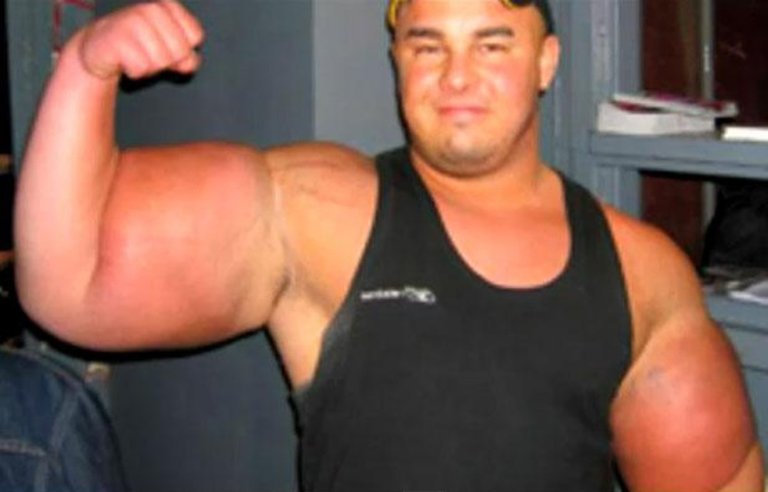 830x532_synthol-plein-bras.jpg