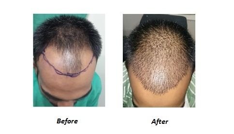 hair-transplant-vplant-hairclinic-kerala-before-after.jpg