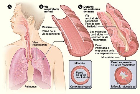 asthma_sp_May2015.jpg