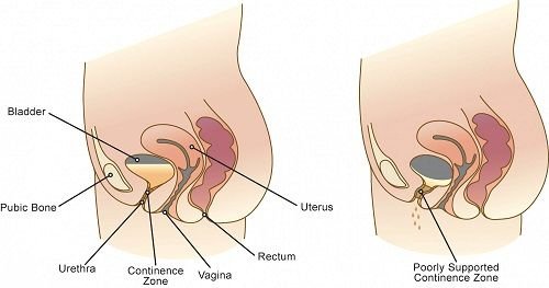 Stress-Urinary-Incontinence.jpg