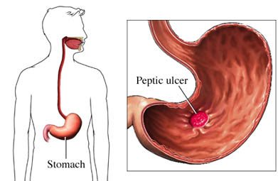 peptic-ulcer.jpg