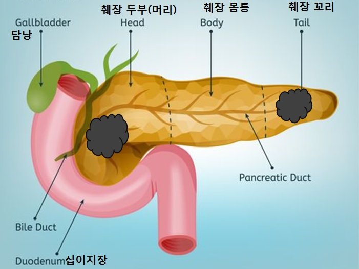 췌장 모식도.jpg