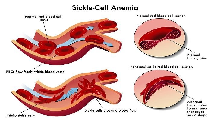 Risk-Factors-for-Sickle-Cell-Anemia_(1)2.jpg