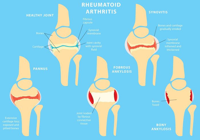 vector-joint-rheumatoid-arthritis.jpg