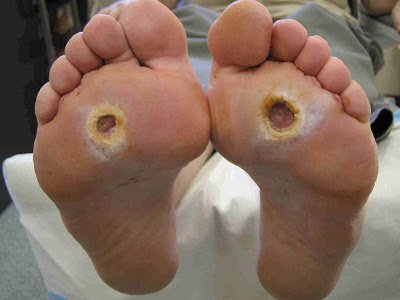 How To Prevent The Onset Of Diabetic Foot Ulcers.jpg