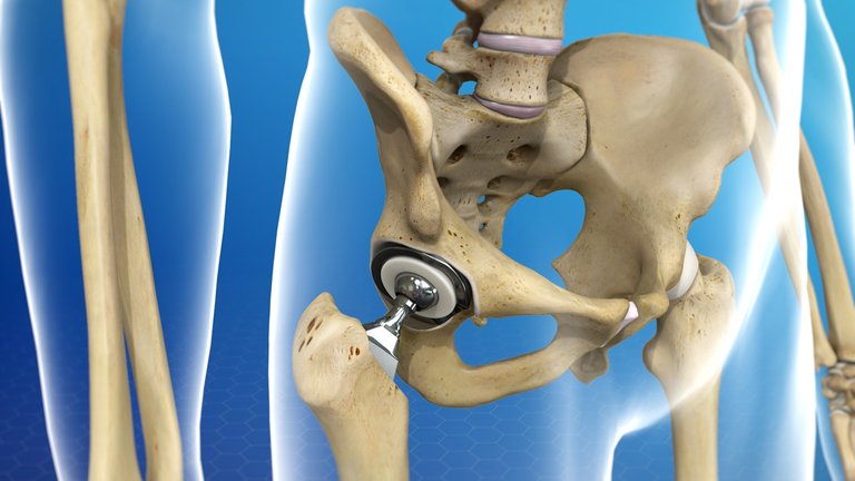 hip replacement.jpg